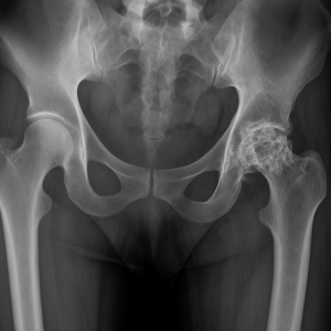 kalça kemiği çürümesi